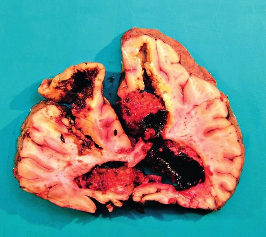 Frontální řez mozkem v oblasti frontálních laloků
Pitva fixovaného mozku
I přes fixaci je mozková tkáň anatomicky málo přehledná a potrhaná. Mozek prokrojen ve frontálních řezech po 2 cm. Ve frontálním laloku vlevo hemoragie a vs malatické ložisko velikosti 4 x 3cm. Rozsáhlé krvácení je v pravé hemisféře, zasahuje od zadní části frontálního laloku až k laloku okcipitálnímu a propaguje se do postranní mozkové komory velikosti přibližně 12 x 8 x 7 cm. Další hemoragické ložisko je v okcipitálním laloku vlevo velikosti 6 x 5 x 5 cm. Mozeček na řezu přiměřený, pons a oblongata s drobnými hemoragickými ložisky. Spodinové arterie jsou převážně jemné s ojedinělými lipoidními pláty. Mozkové pleny jemné, lehce překrvené.
