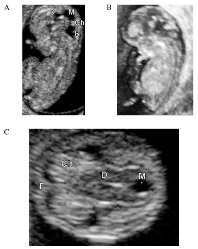 UZ zobrazení embrya v 11. týdnu. 2D obraz (A), 3D rekonstrukce (B), transverzální řez v úrovni III. komory (C). CRL = 35,4 mm.
D – diencefalon (III. komora), M – mezencefalon, R – rombencefalon (IV. komora), Ch – choroidní plexus postranní komory, F – falx cerebri