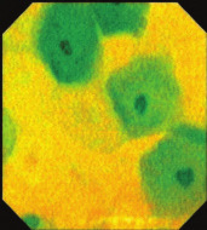 Endocytoskopický obraz buněk sliznice jícnu s odstraněním hlenu