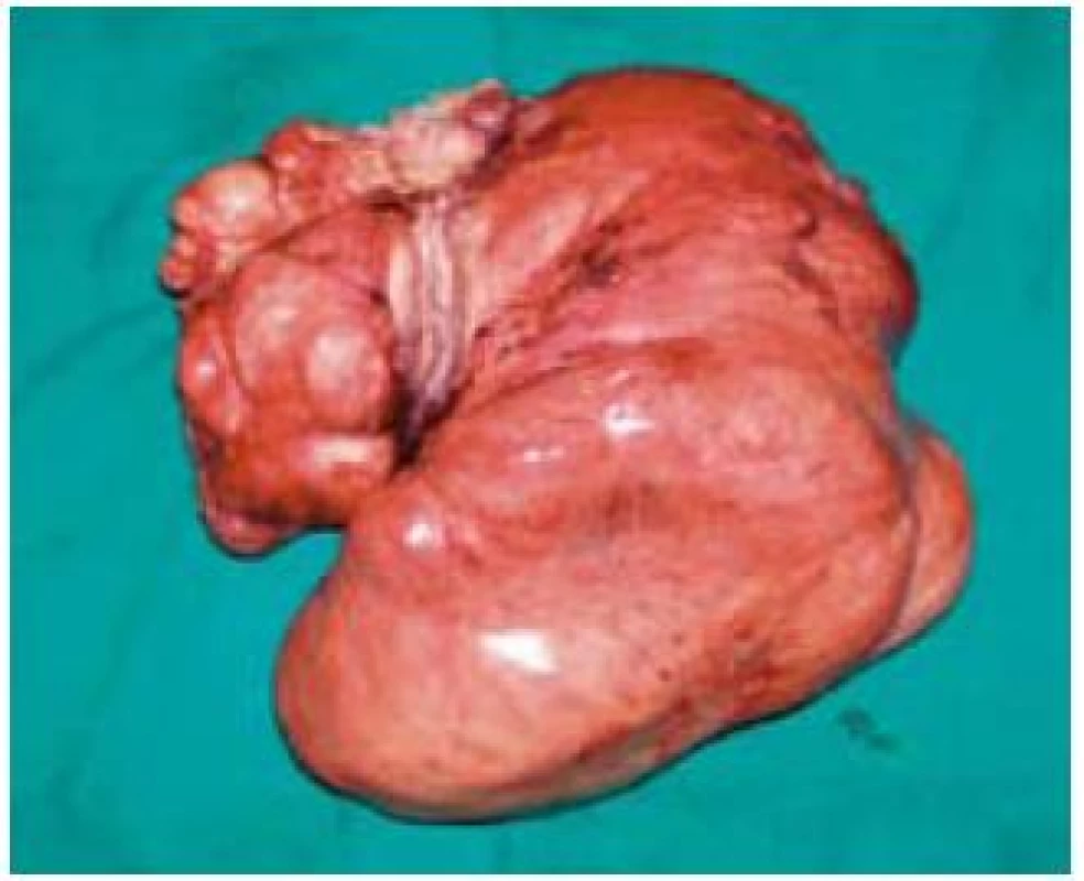 Peroperačný resekát tumoru so zavzatými kľučkami tenkého čreva.
Fig. 2. The surgical resection specimen of a tumour with small intestine loops.