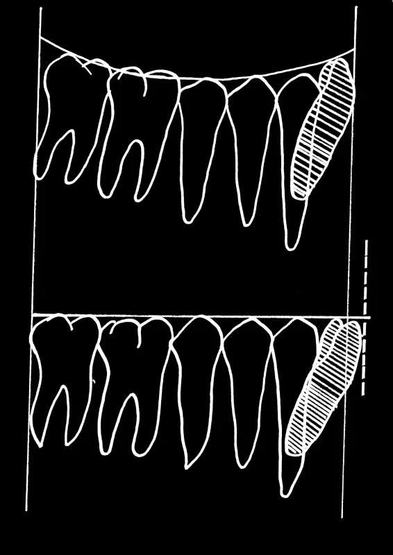 Protruze řezáků během vyrovnání Speeovy křivky (Woods, 1986)