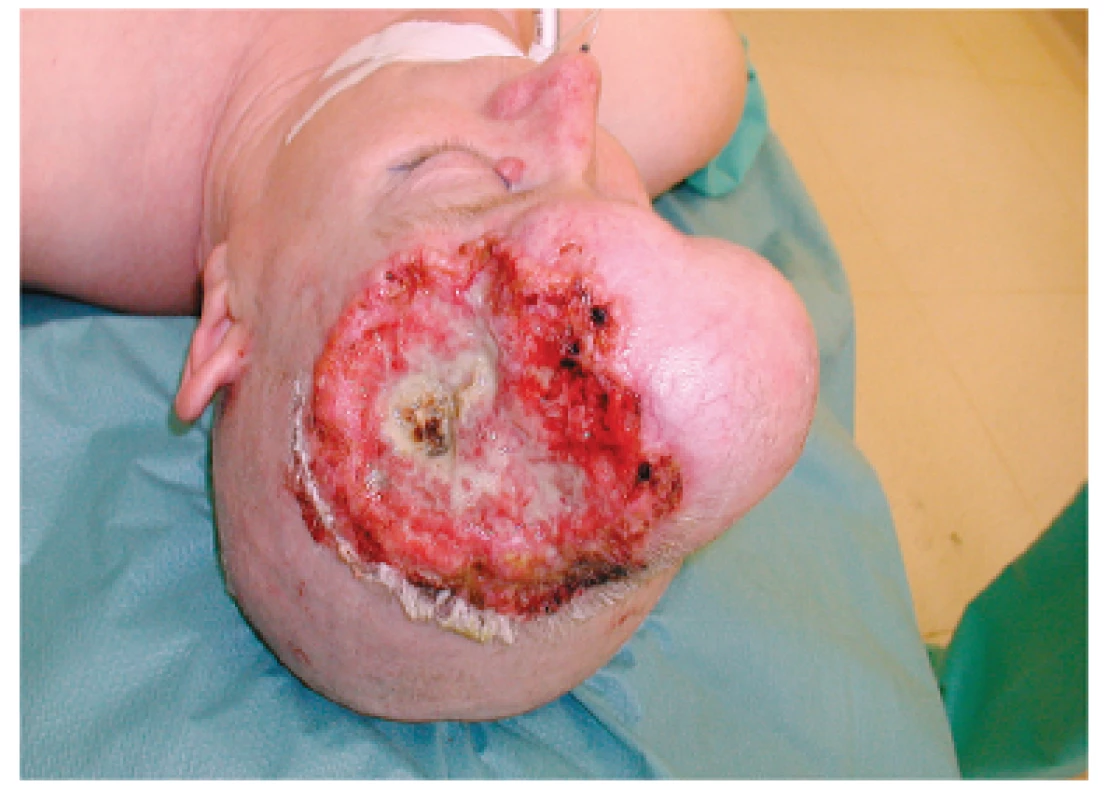 Pacientka pred operáciou. Pohľad na rozsiahly ulcerovaný nádorový útvar vo fronto-parietálnej časti hlavy. Snímka poskytnutá láskavosťou prim. MUDr. Ivana Mačugu.