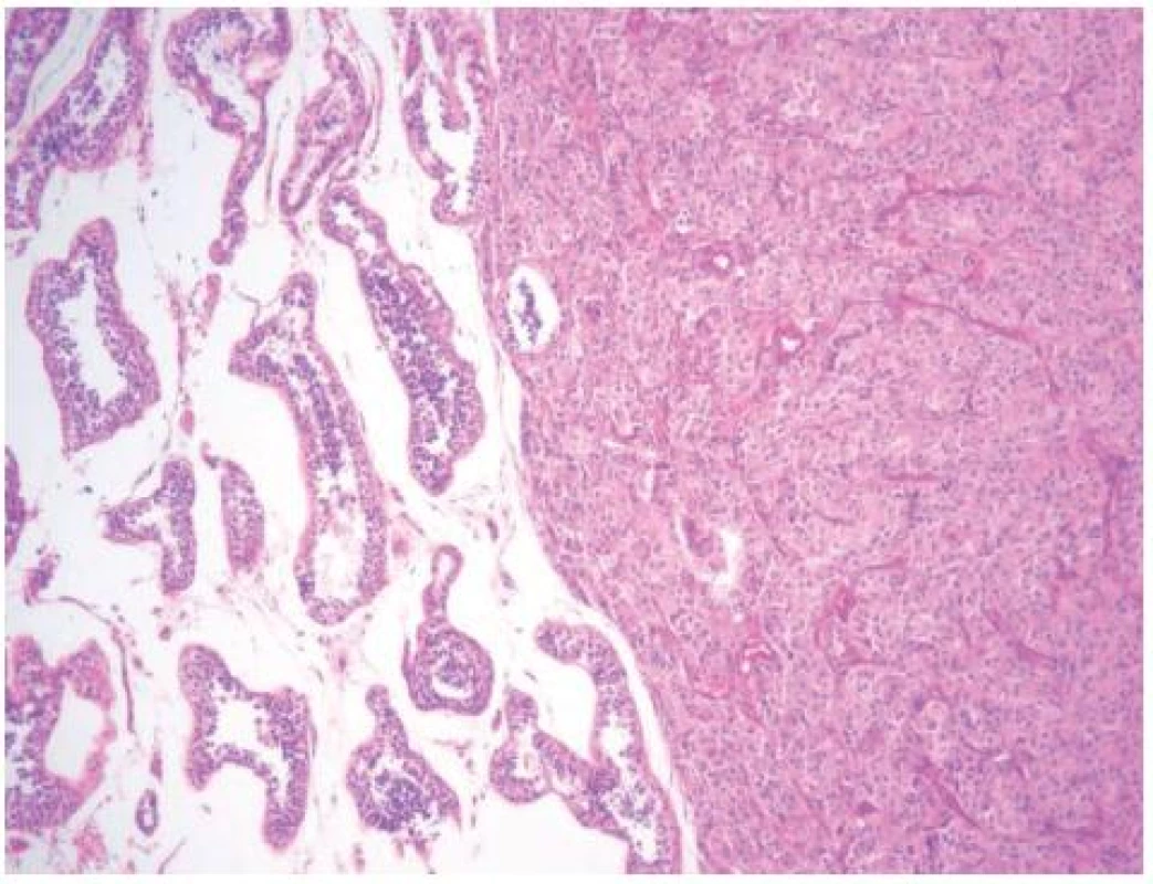 Vpravo patrný nádor z Leydigových buněk, vlevo normální parenchym varlete
Fig. 1. Right side, Leydig cell tumor; left side, normal parenchyma of the testis