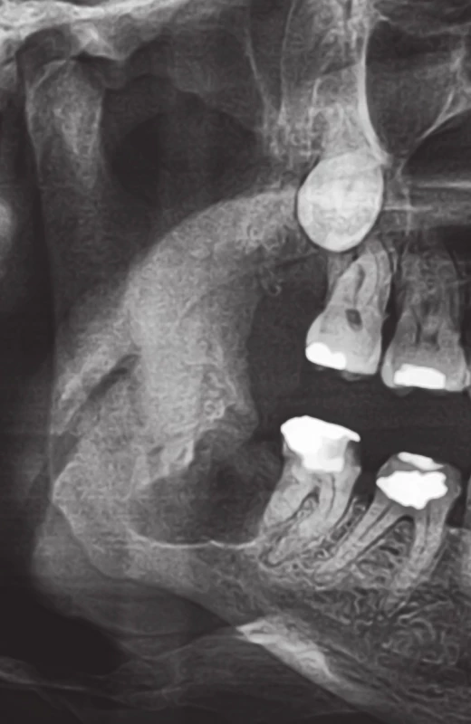 Výřez z ortopantomogramu pacienta z obrázku 1. Stav 3 měsíce po maximálně kost šetřící chirurgické extrakci zubu 48, která proběhla při dodržení všech preventivních opatření. Extrakční rána je radiologicky bez jakýchkoliv známek hojení, čemuž odpovídal i klinický nález. Posléze v této lokalizaci došlo k rozvoji osteonekrózy mandibuly.
Fig. 2. A part of the panoramic X-ray of the patient in Figure 1. The state 3 months after the maximally bone-sparing surgical extraction of the tooth 48, which was performed in the line with preventive measures. The extraction wound is radiologically without any signs of healing, which corresponded with clinical fi ndings. The osteonecrosis of the mandible developed subsequently in this area.