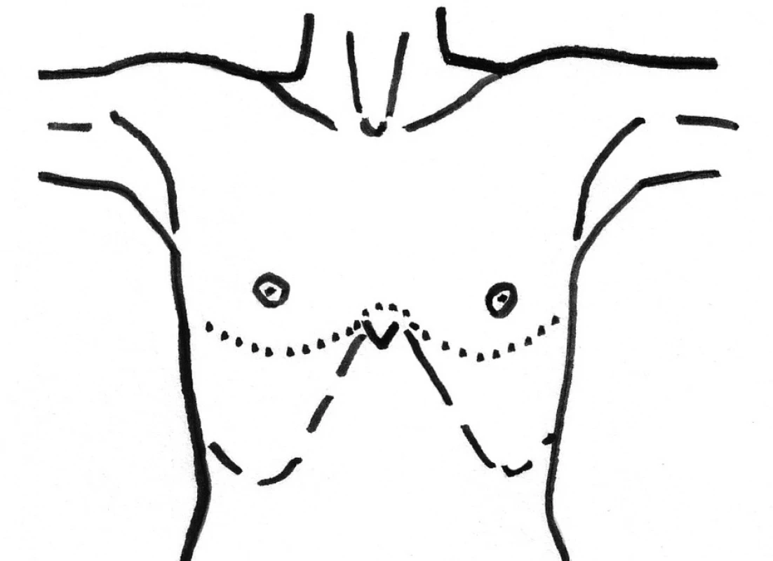 Clamshell incision, řez označen tečkovaně
Fig. 5. Clamshell incision, the incision is marked by a dotted line