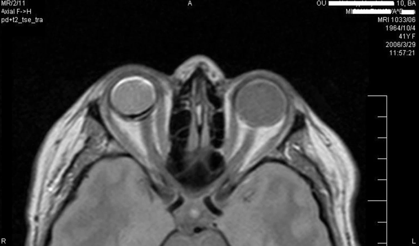 MRI vyšetrenie 1 rok po pars plana vitrektómii, endoresekcii tumoru a aplikácii silikónového oleja (v r. 2006)