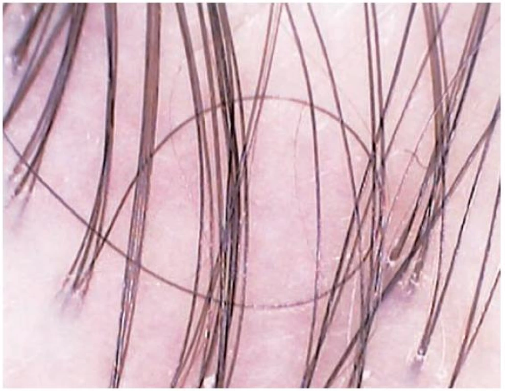 Jizvící alopecie – white dots, bělavé a bledě růžové plošky bez folikulárních ústí, tufted hairs