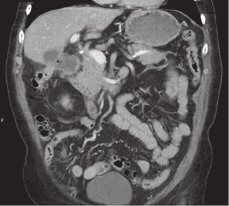 CT obraz cholecystoduodenální píštěle s konkrementem v duodenu – tzv. Bouveretův syndrom
Fig. 1: CT image of cholecystoduodenal fistula with a gallstone in the duodenum – Bouveret syndrome