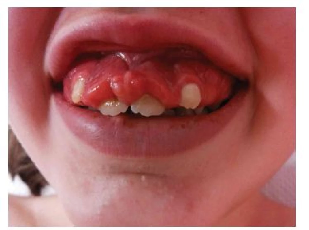 Fibromy dásní u dívky s tuberózní sklerózou