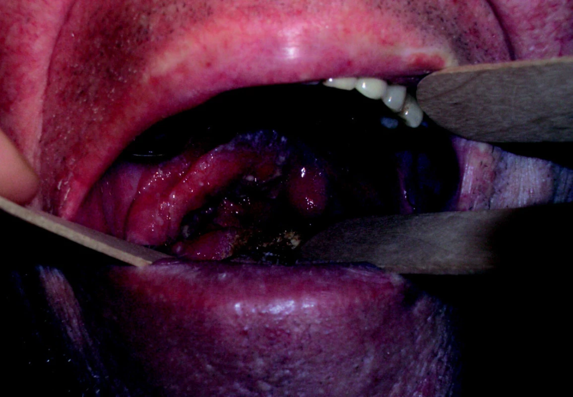 Lokálně pokročilý spinocelulární karcinom orofaryngu a dutiny ústní, vycházející z patrové tonzily vpravo.