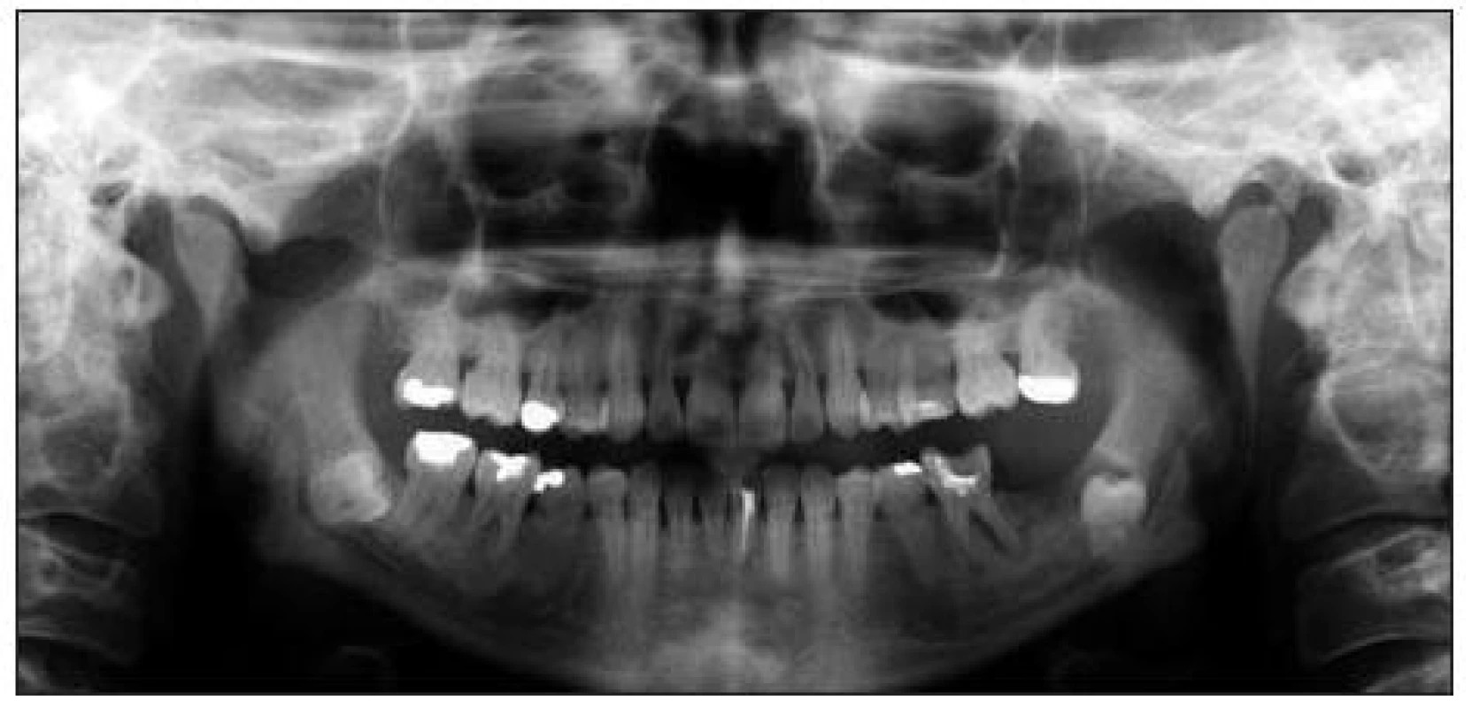 Ortopantomogram s projasněním kolem korunky retinovaného zubu 38, prázdným lůžkem po zubu 37 a kazem destruovaným zubem 36