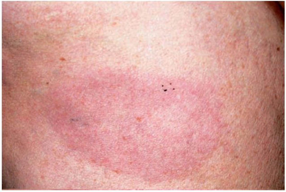 Granuloma anulare – erytematózní forma
(Dermatovenerologická klinika 1. LF UK a VFN)
