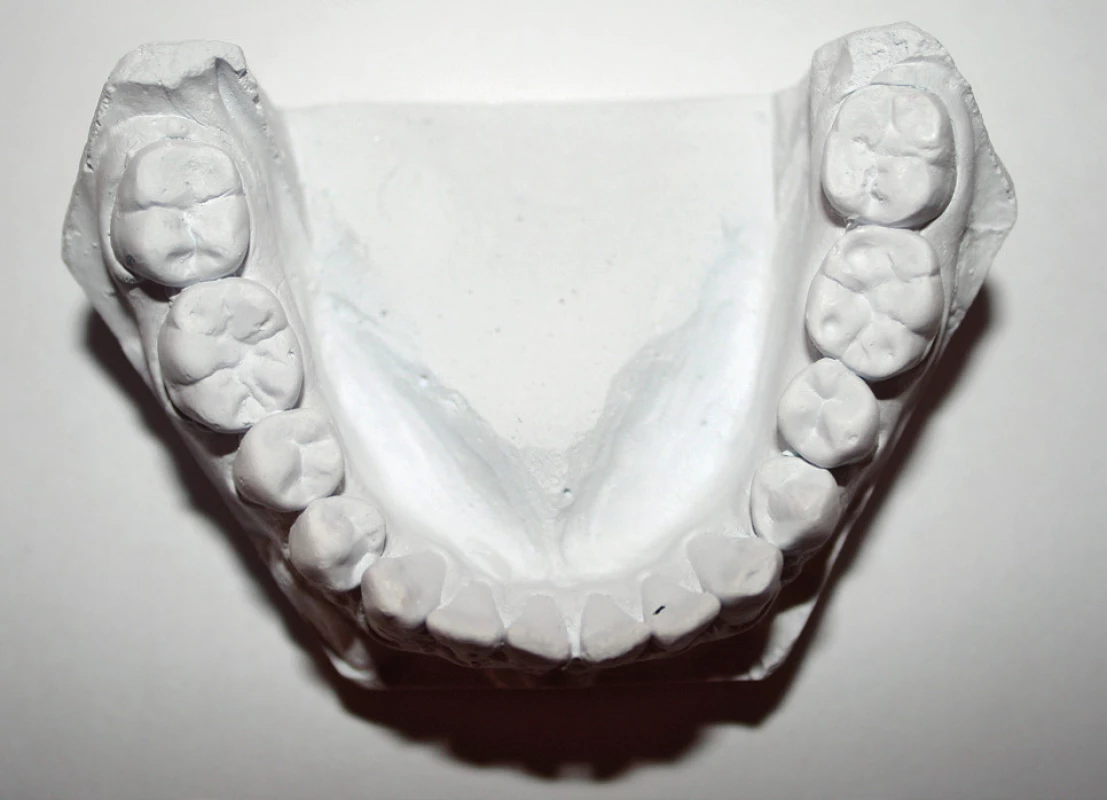 Ztráta tvrdých zubních tkání na hrbolcích dolních molárů. Pravděpodobnou příčinou je kombinace faktorů – atrice v důsledku okluzních interferencí (klinickým vyšetřením byly zjištěny balanční a hyperbalanční kontakty na molárech) a koroze vzniklá konzumací kyselých jídel a nápojů (viz „cupping“ v oblasti hrbolků zubu 36) (pacient 25 let)