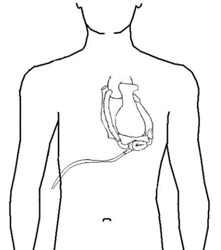 Nepulzatilní typ levokomorové podpory
Fig. 2: Non-pulsatile left ventricular support