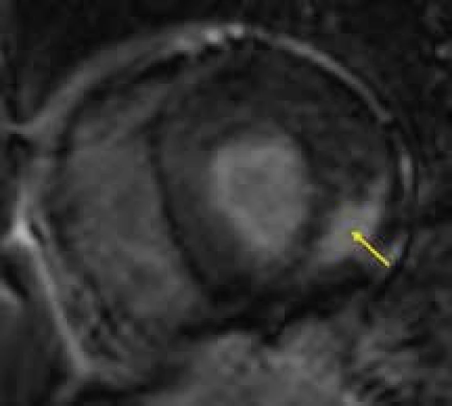 Midmyokardiální ložisko pozdního sycení segmentu posterolaterální stěny levé komory (žlutá šipka) u nemocného s Fabryho chorobou;