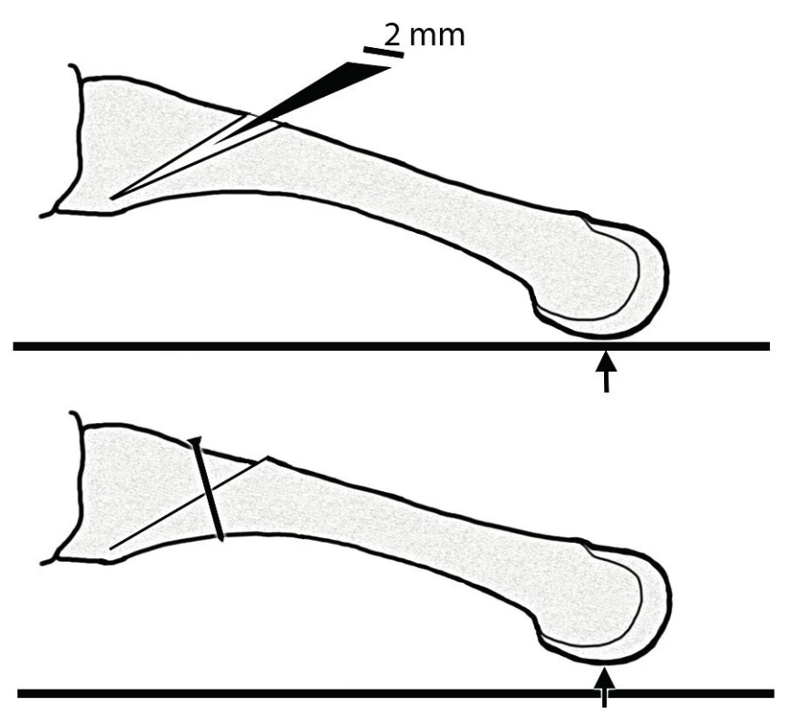Boční pohled na druhý metatarz; schématické znázornění BRT (Barouk, Rippstein, Toullec) osteotomie; klínovitá osteotomie je vedena z distální a dorzální oblasti v bazi metatarzu směrem plantárním; osteotomie je fixována jedním šroubem; černá šipka - místo zátěže hlavičky metatarzu.