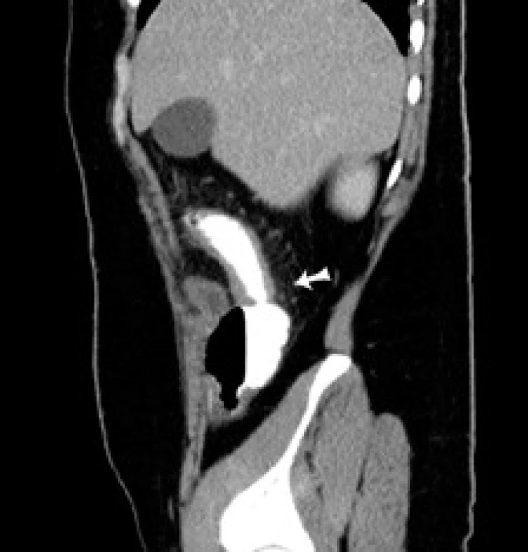 CT sagitálny rez: šípka označuje pôvodne suponovanú stenózu ileoascendentnej anastómózy.
Fig. 4. CT of sagital cross-section: arrow indicates originally supposed stenosis of the ileoascendental anastomosis.