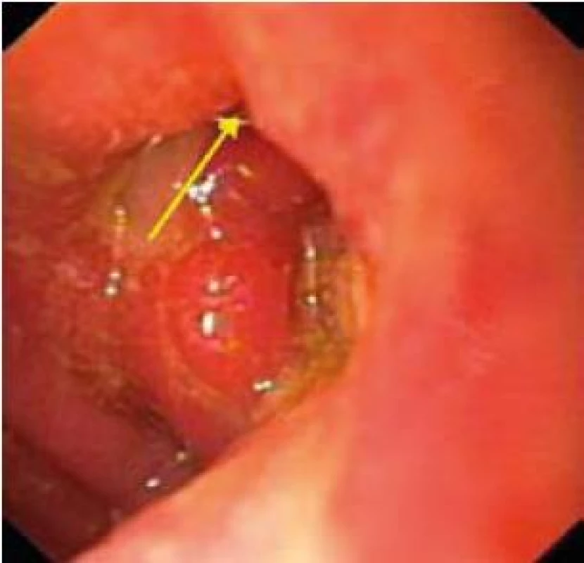 Gastroskopia: fistula v spodine chronického vredu anastomózy Billroth II.
Fig. 1. Upper endoscopy: fistula in the base of chronic ulceration in Billroth II-nd type gastroenteroanastomosis.
