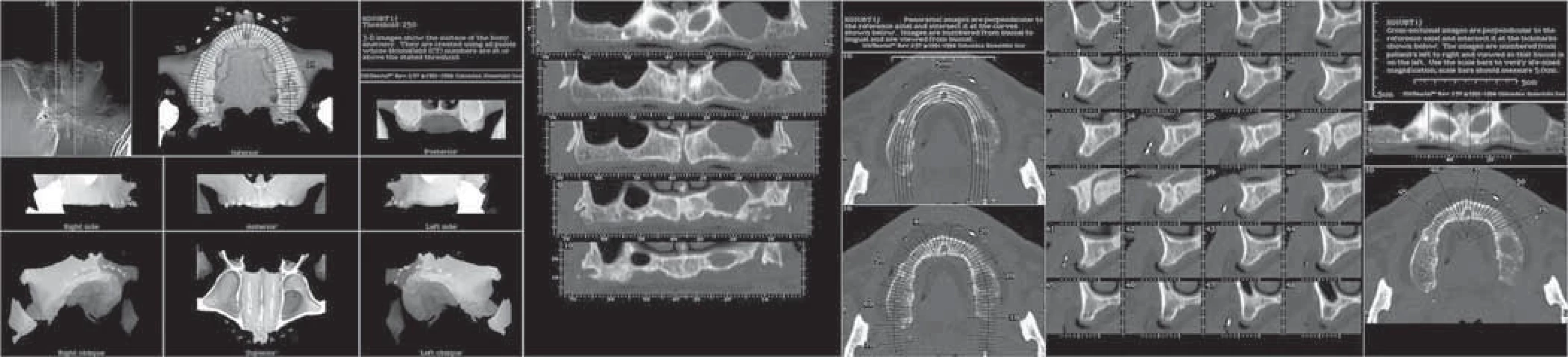 CT console at the Radiological department enabled window level setting, (WL – also known as grey-level mapping, or brightness/contrast enhancement), and more detailed analysis by adjustable sectional images and measurements.