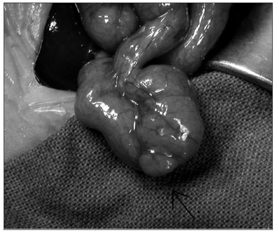 1. Makroskopický obraz heterotopie žalúdočnej sliznice v stene duodena.
Fig. 1. Macroscopic picture of stomach mucosa heterotopy of duodenal wall.