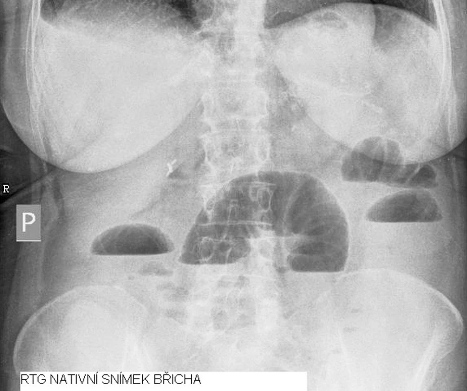 RTG nativní snímek břicha
Fig. 1. Native abdominal x-ray