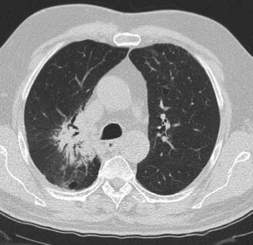 Kontrolní CT hrudníku pacienta č. 1 v době probíhající léčby erlonitibem.
Obrázek zobrazuje stacionární velikost tumoru horního laloku pravé plíce a regresi dys-/atelektatických změn horního laloku pravé plíce. Efekt léčby erlotinibem – stabilizace nemoci (červenec 2016).