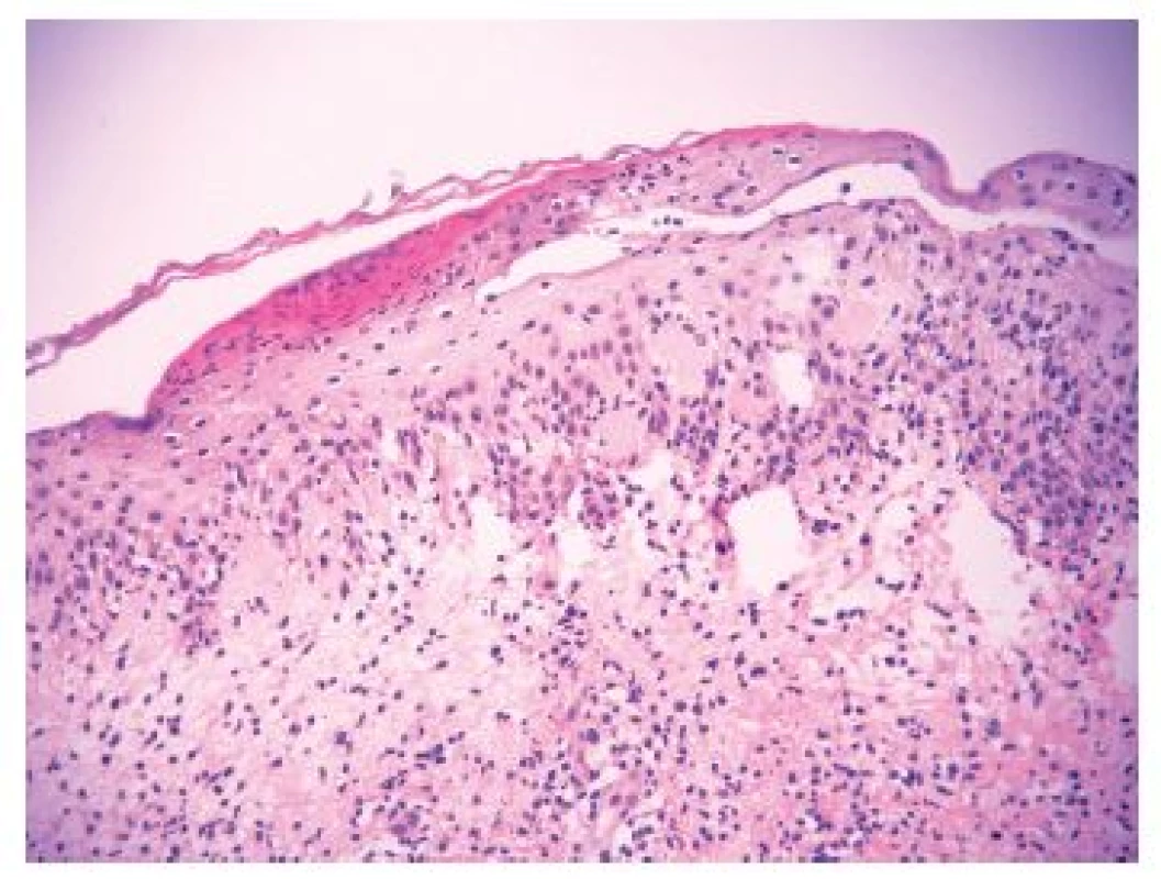 Fokální povrchní nekróza epidermis (červenější úsek), hydropická degenerace stratum basale