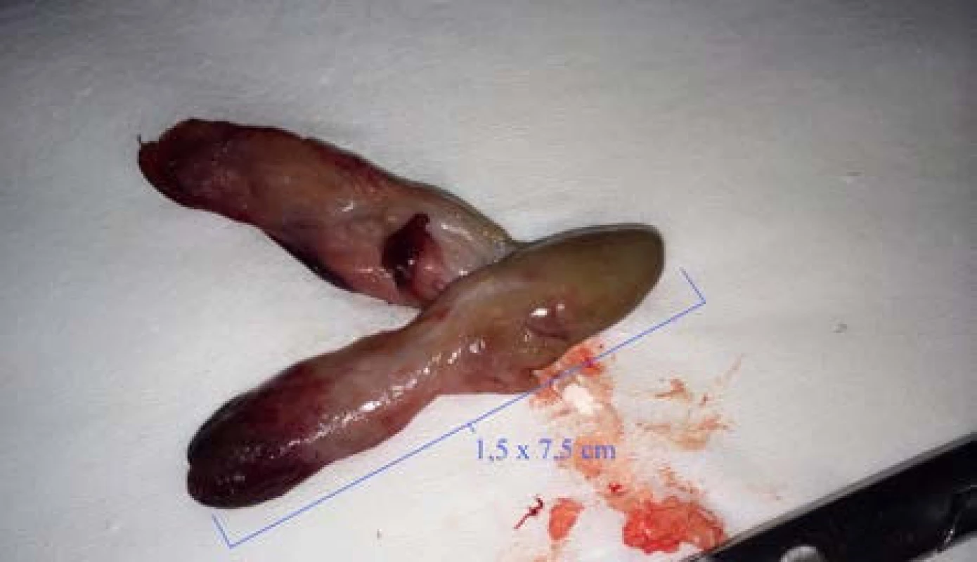 Nádor vypuzený z uretry
Fig. 2. Tumor expelled from the urethra