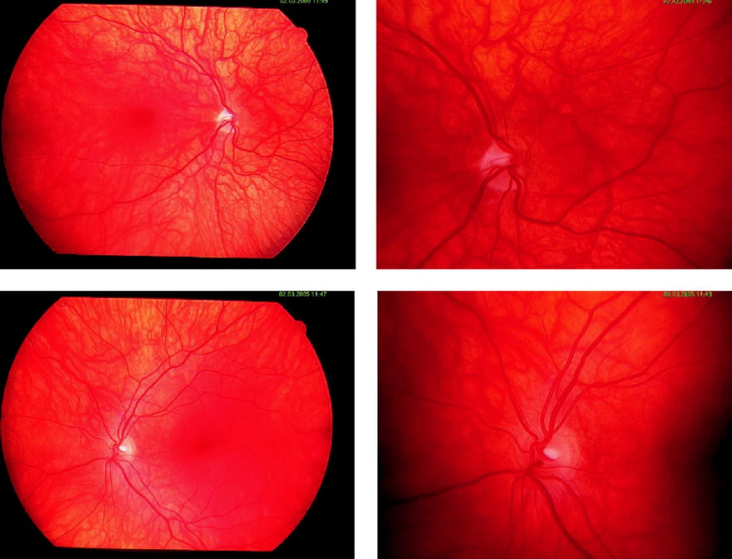 Retinogram pacientky č. 1 (horný rad – pravé oko, dolný rad – ľavé oko)