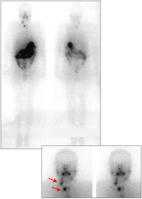Celotělová a statická scintigrafie krku po téměř totální tyreoidektomii provedená 5 dní po aplikaci 2600 MBq &lt;sup&gt;131&lt;/sup&gt;I