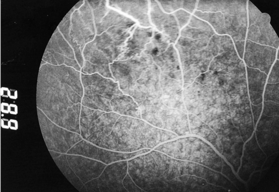 Fluoresceínová angiografia z 19. 4. 2004: regresia očného nálezu bez rozvoja neovaskularizácií, s miernym presakovaním farbiva z postihnutých ciev do okolitej sietnice
