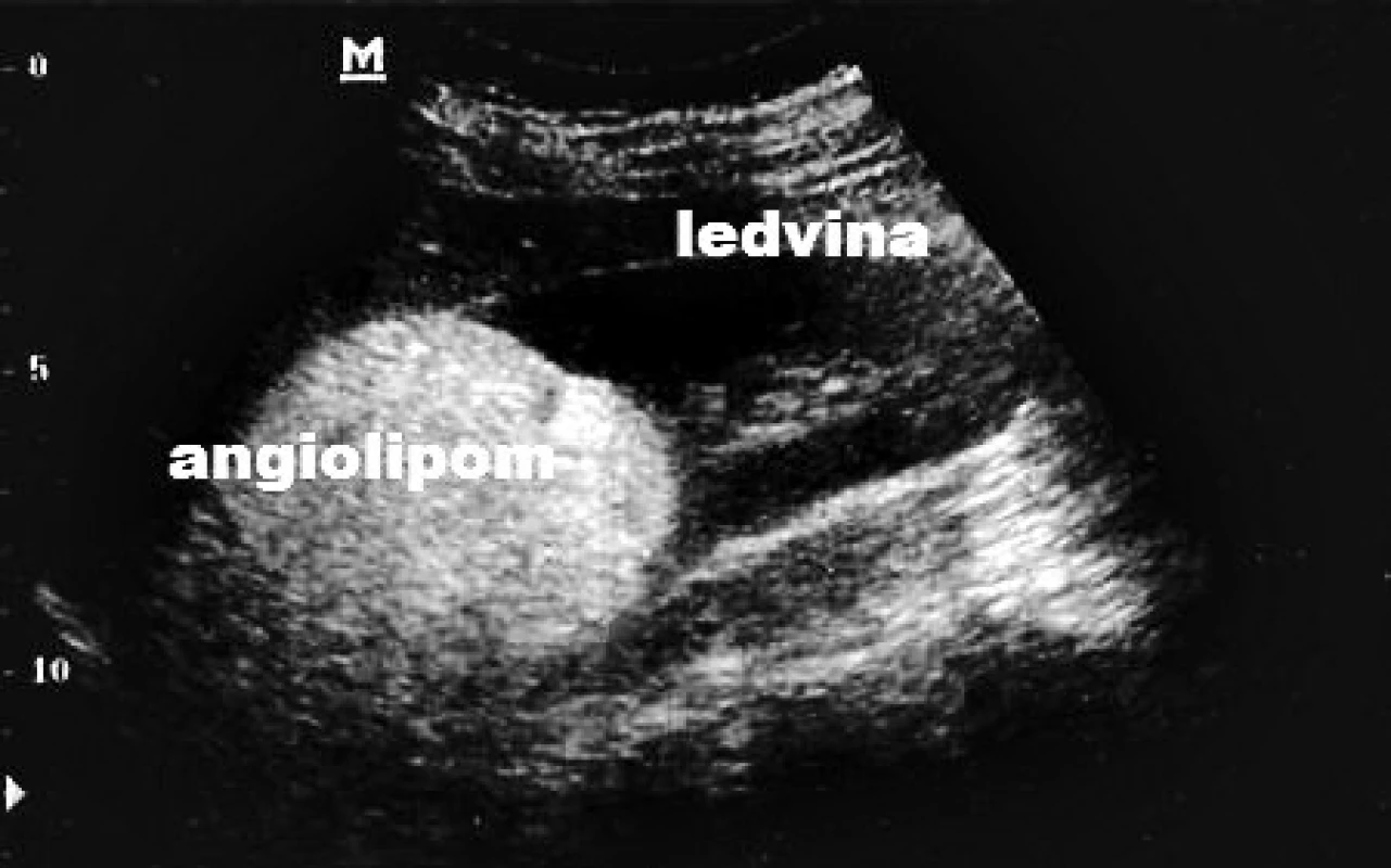 Ultrazvukový nález angiolipomu ledviny u dětského pacienta