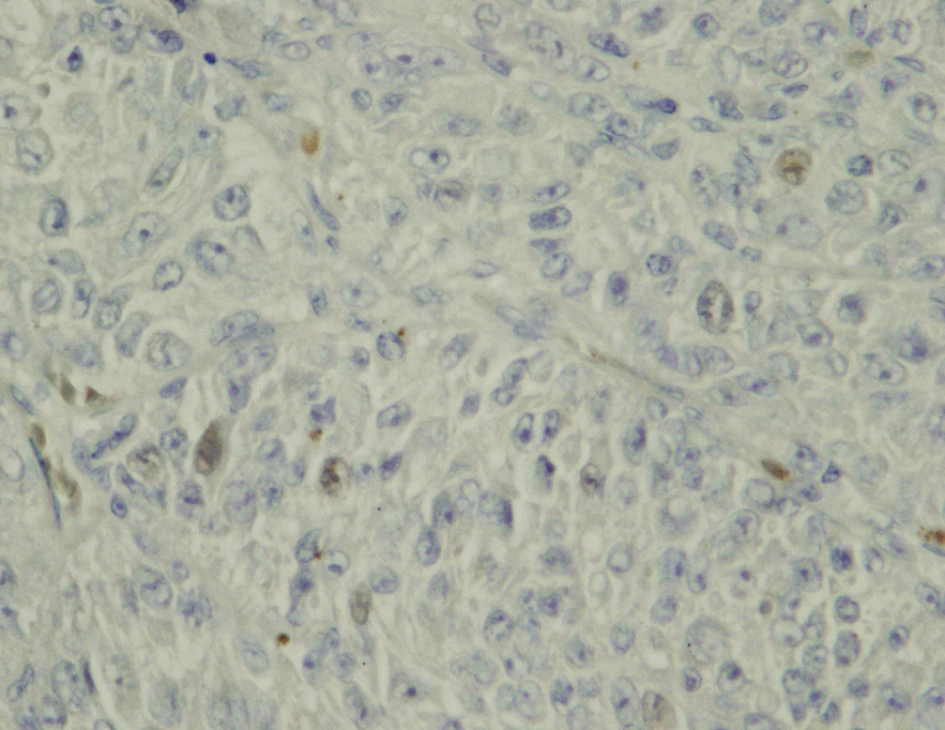 Imunohistochemický průkaz exprese p21 v buňkách maligního melanomu uvey, prokázána akumulace p21 v jádrech některých buněk (původní zvětšení 800krát)