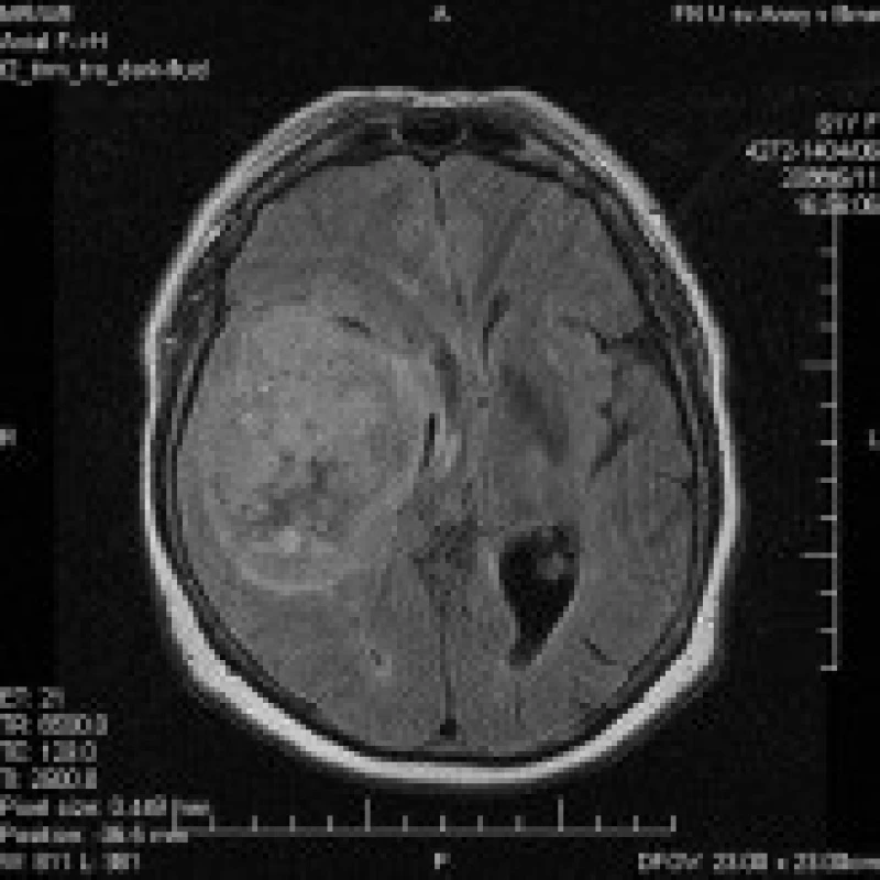 MRI mozku, axiální řez, T2 darkfluid vážený obraz. Nehomogenní, sytící se tumor s expanzivními projevy.