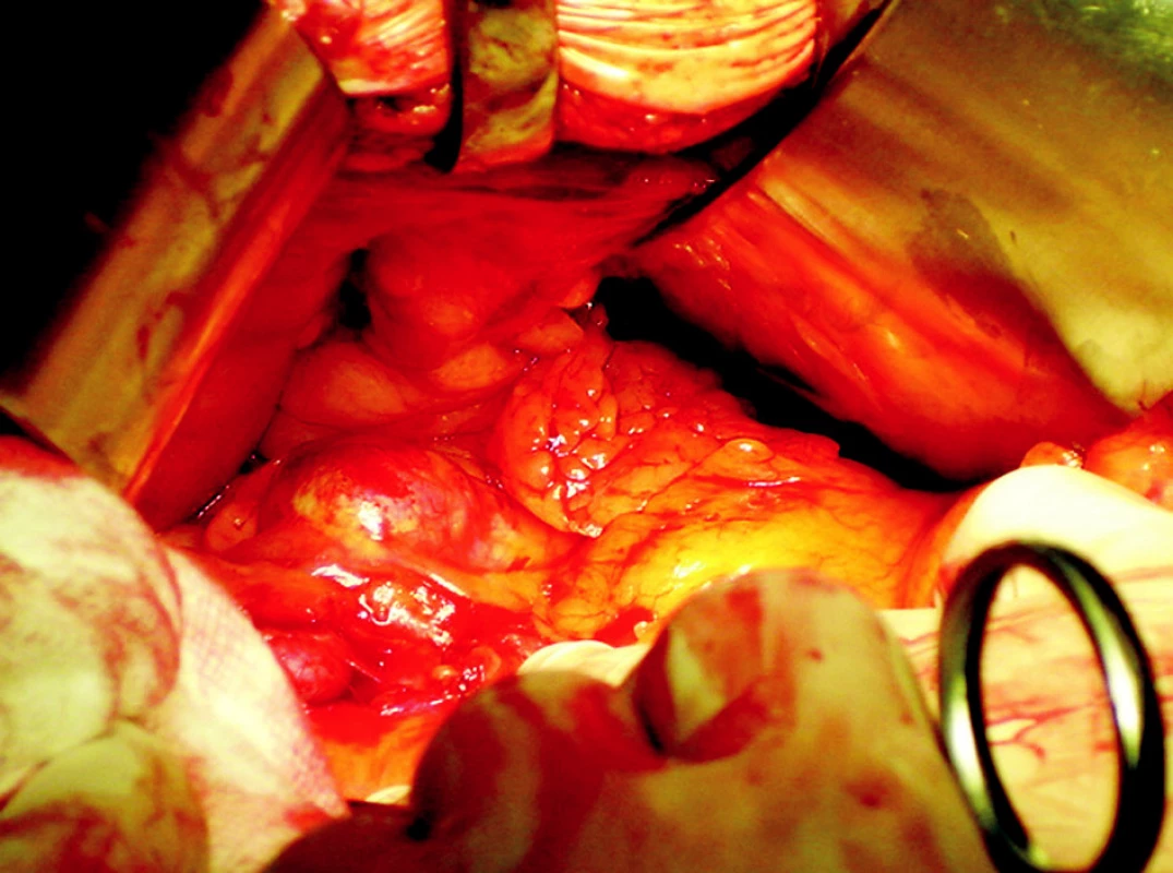 Peroperační nález u aneuryzmatu slezinné tepny
Fig. 3. An intraoperative finding of the lienal artery aneurysm
