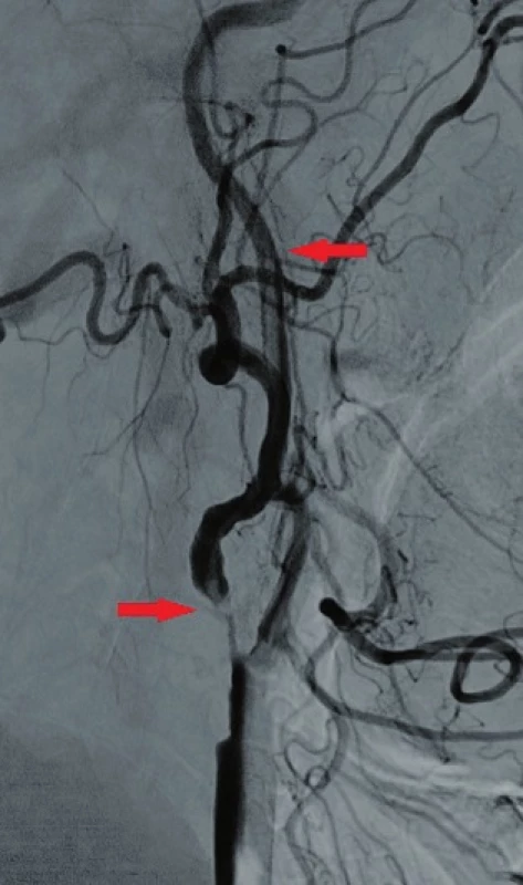 Angiografické zobrazení stenozy a volně vlajícího trombu
Fig. 4: Angiography presenting the stenosis and the free-floating thrombus