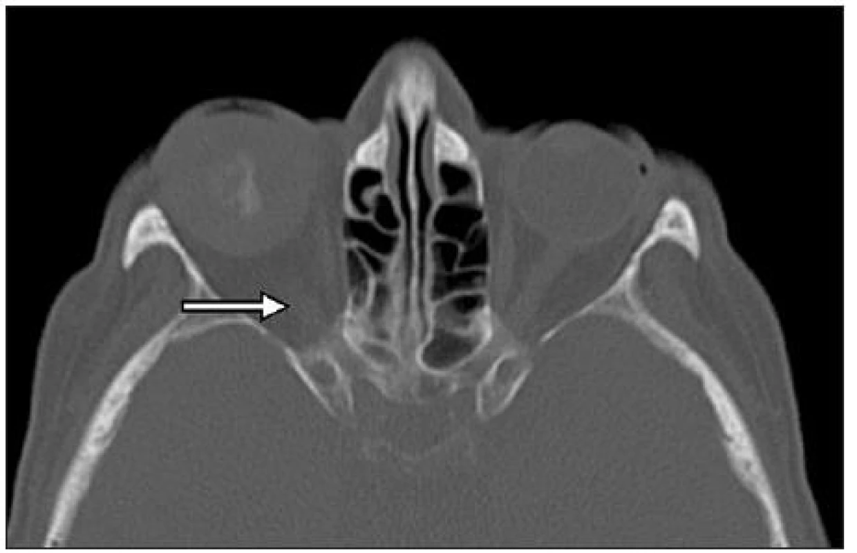 CT snímka očníc u pacientky – vpravo v priestore očnice sférický útvar imponujúci ako očná guľa, nemá však kontakt so zvyškom zrakového nervu v hrote očnice (šípka)
