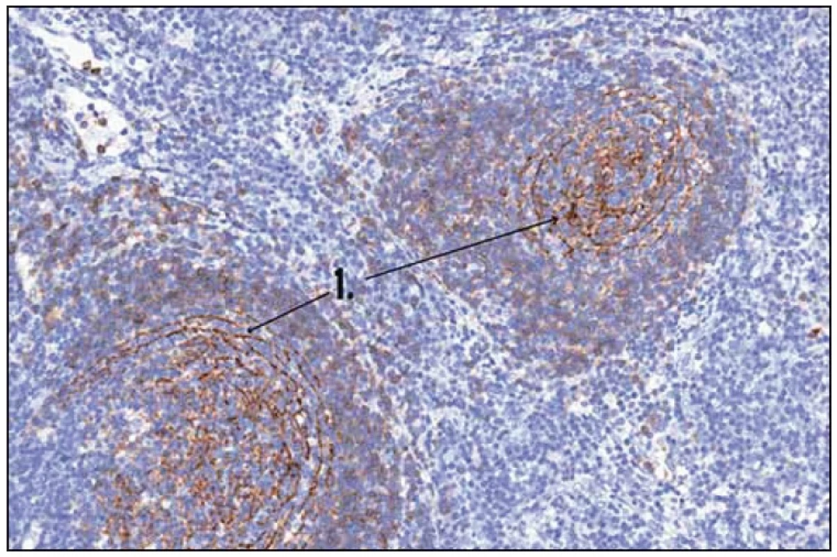 Histologický obraz Castlemanovy nemoci. 1 – CD 23 (FCRII) – folikulární dendritické buňky.