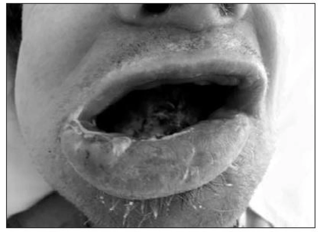 Sarkom jazyka (detailní pohled na rty a ústní dutinu)