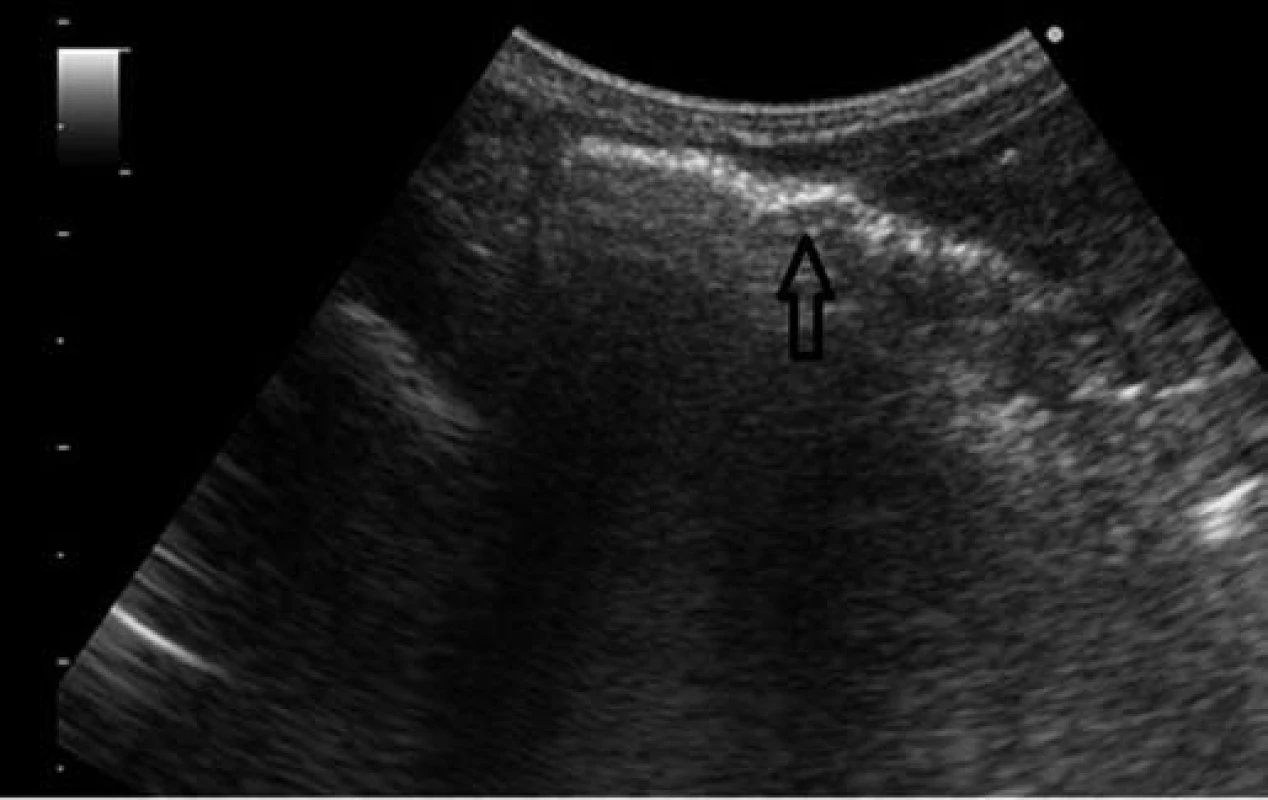 Sonografické vyšetrenie – vzduch v črevnej stene.
Fig. 4. Sonographic examination – air in the intestinal wall.