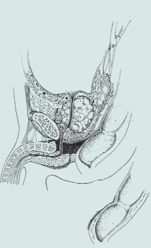 Stav před radikální cystektomií s Millinovou prostatektomií [31].
