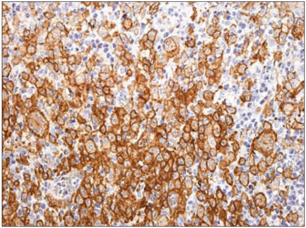 CD1a – imunohistochemické vyšetření. Silná membránová a slabší granulární pozitivita v cytoplazmě Langerhansových buněk (hnědý precipitát), jádra dobarvena hematoxylinem.