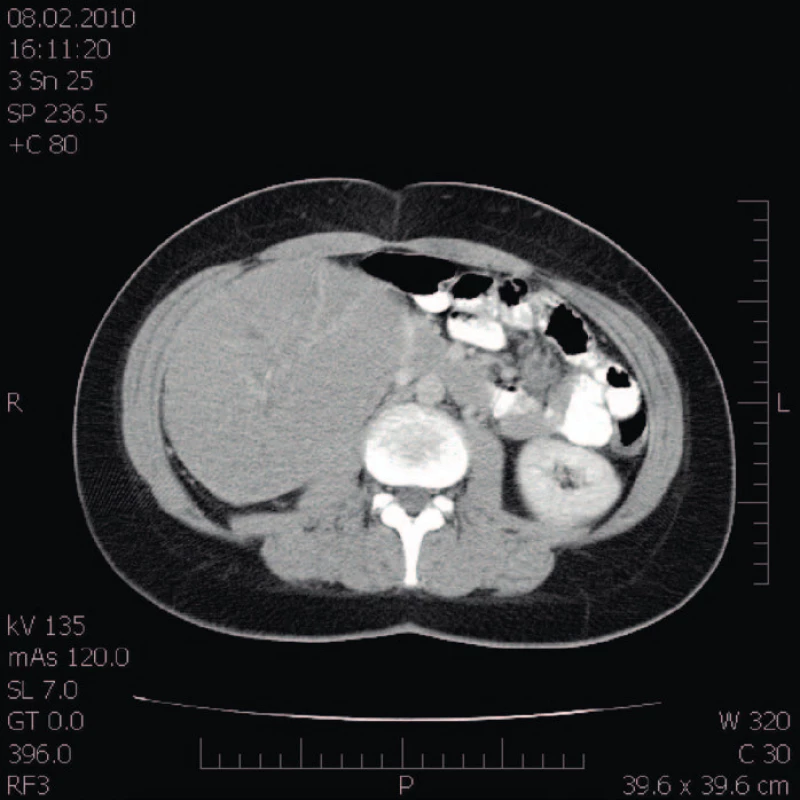CT obraz tumoru pravé ledviny.