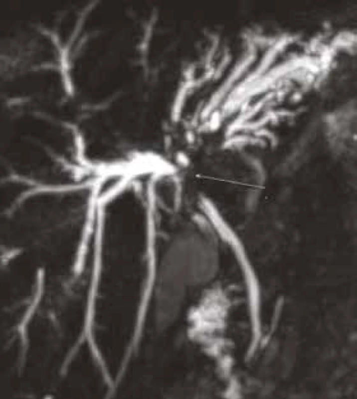 Pacient (1960): patrný štíhlý ductus choledochus.