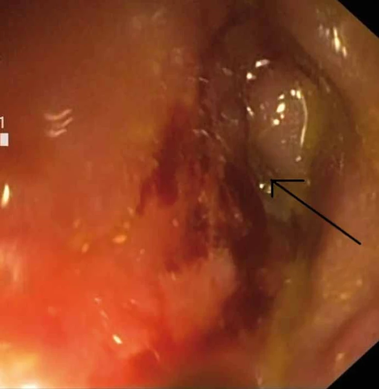 Stenóza střeva při vstupním vyšetření (označeno lumen). 
Fig. 1. Stenosis of the bowel at baseline (marked lumen).