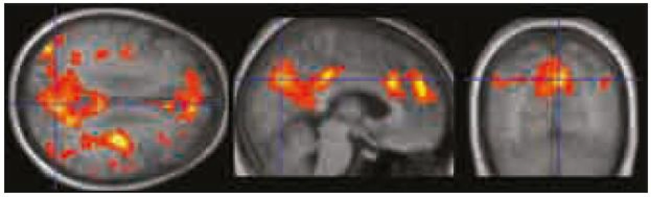 Oblasti zapojené do DMS identifikované pomocí „seed“ analýzy jsou rovněž zadní cingulum/precuneus, ventromediální prefrontální kortex/přední cingulum a gyrus angularis/lobulus parietalis inferior bilaterálně.
V porovnání se zobrazením deaktivací je tato mapa rozsáhlejší a lépe koreluje s výsledky ICA analýzy. Zobrazeno při p &lt; 0,0001 nekorigovaně.
