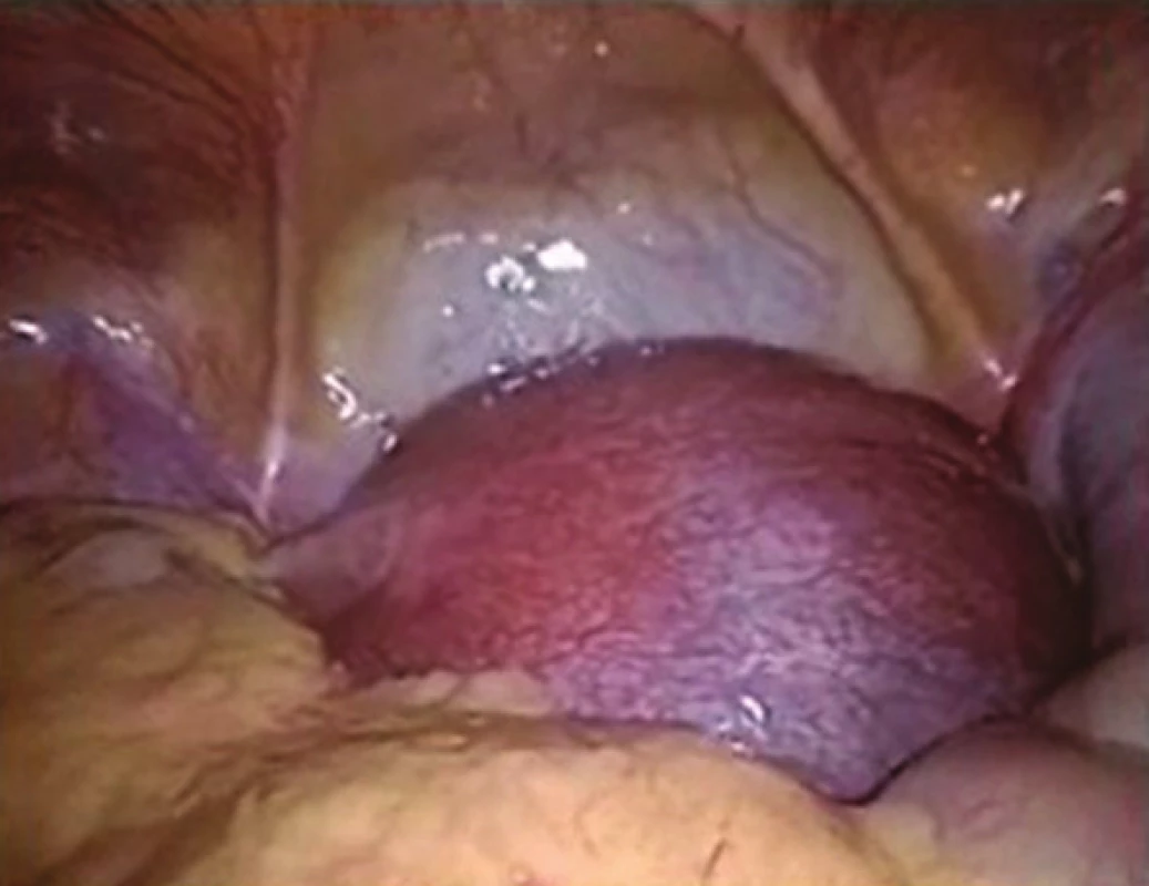 Pohled na těhotnou dělohu
Fig. 1: View of the gravid uterus