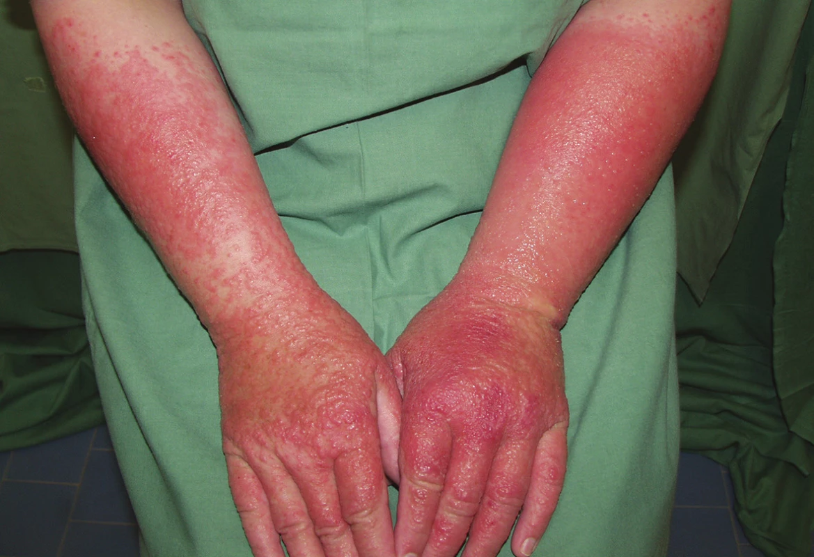 Alergická kontaktní dermatitida po ketoprofenu