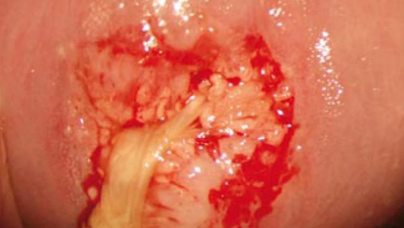 Kolposkopický obraz adenocarcinoma in situ – vzájemně splývající papily cylindrického epitelu, bílé po kyselině octové (pacientka č. 8).