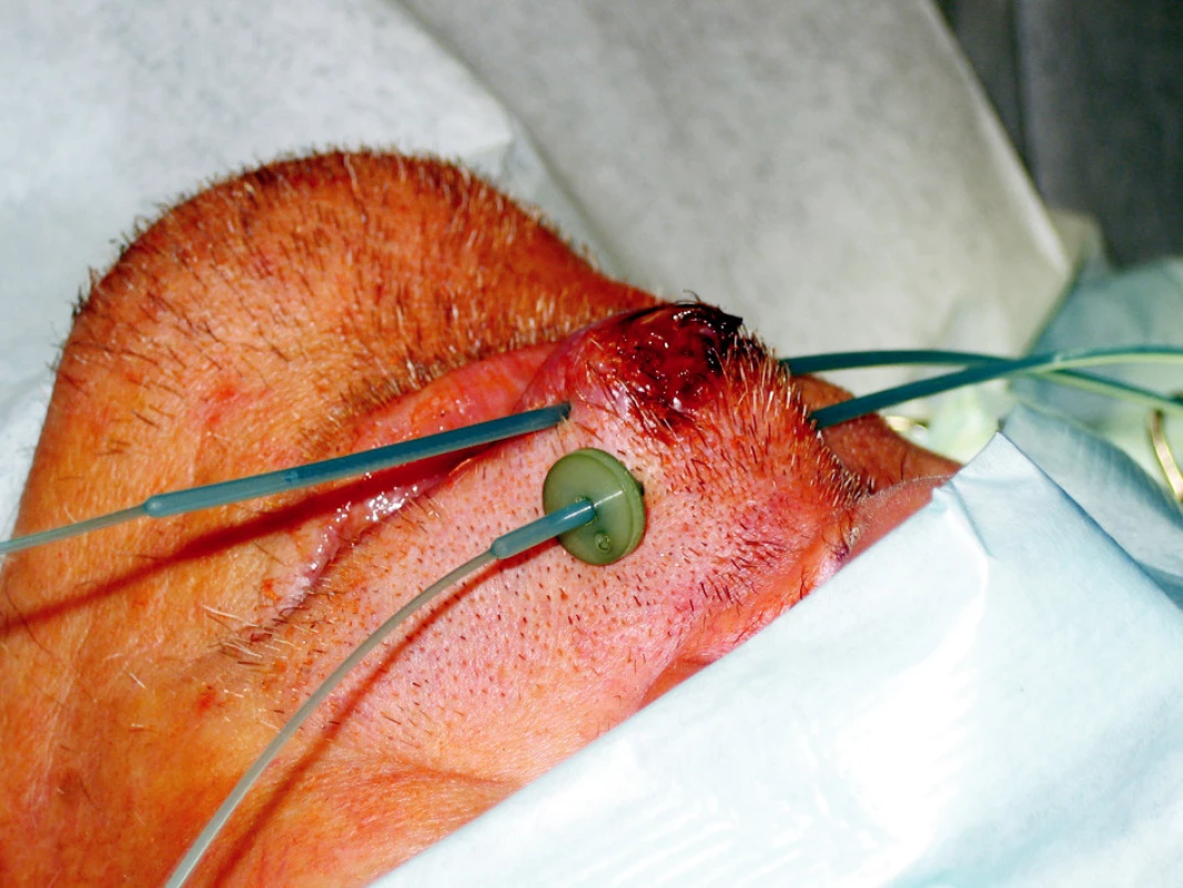 Intersticiální brachyterapie u pacienta s nádorem horního rtu
Fig. 3. Interstitial brachytherapy in a patient with an upper lip tumor